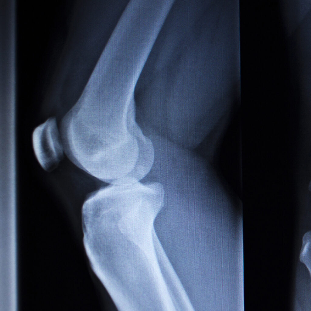 Xray of a knee