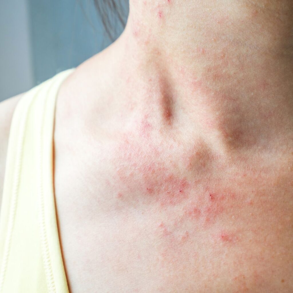 photo of skin rash
